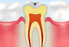 C1：初期のむし歯エナメル質のむし歯