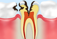 C3：後期のむし歯歯の神経のむし歯