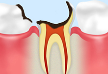 C4：重度のむし歯歯の根のむし歯