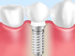 インプラントとは